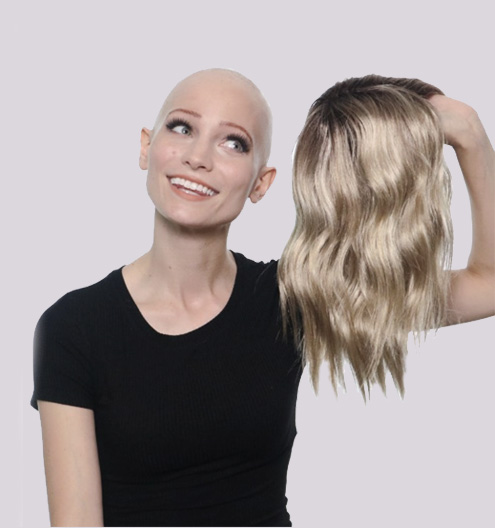 abbey andrews alopecia